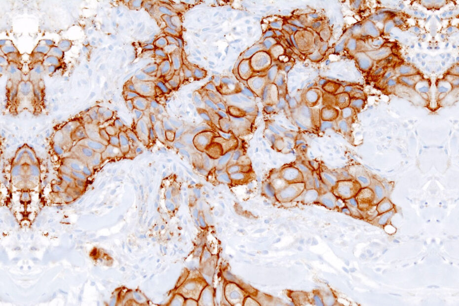¿Que es el carcinoma ductal invasor de grado 3/3 ?